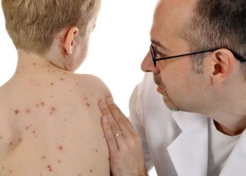 Шымкент қаласында қызылша ауруының эпидкезеңінде 830 жағдай тіркелген